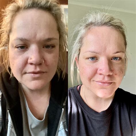 Alcoholics Before And After