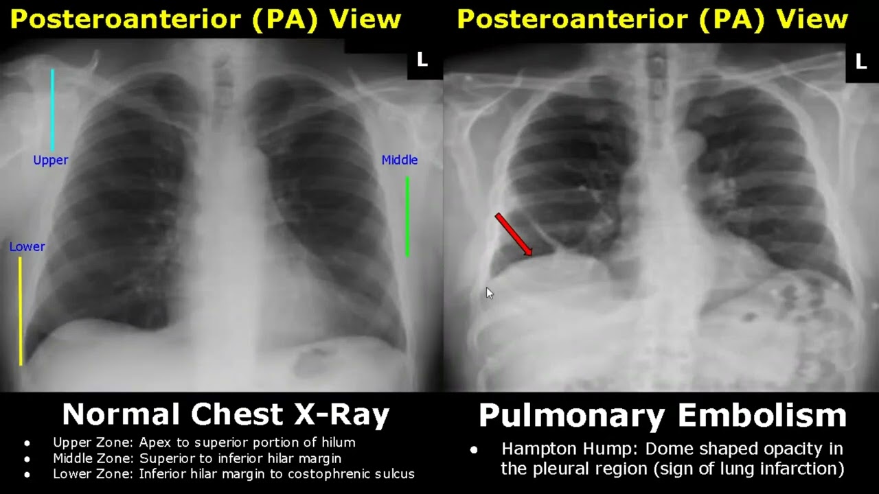 Chest X Rays Explained Short Version Youtube Vrogue Co Chest X Rays Explained Short Version Youtube Vrogue Co