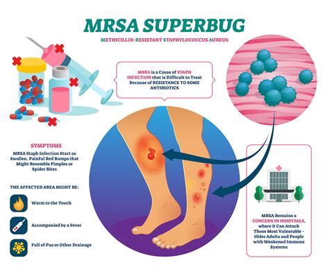 How To Prevent Mrsa