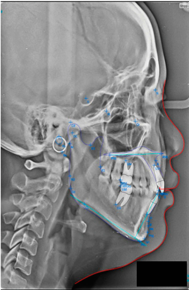 Identification Of Col11a1 Single Gene Polymorphisms In Patients With Identification Of Col11a1 Single Gene Polymorphisms In Patients With