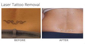 Laser Tattoo Removal Msa Plastic Surgery