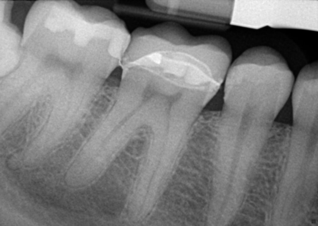 Porcelain Crowns Xray Porcelain Crowns Xray