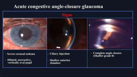 Primary Angle Closure Glaucoma Ppt Primary Angle Closure Glaucoma Ppt
