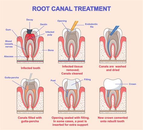Root Canals Root Canal Treatment Endodontist Yorkville Ny