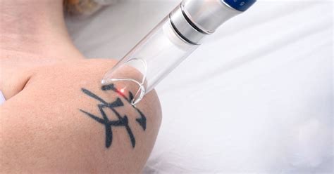 Tattoo Removal Wilmington NC: Safe, Effective Solutions Near You