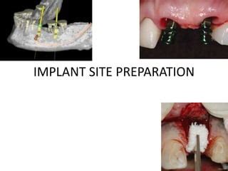 Undersized Implant Site Preparation To Enhance Primary Implant Undersized Implant Site Preparation To Enhance Primary Implant