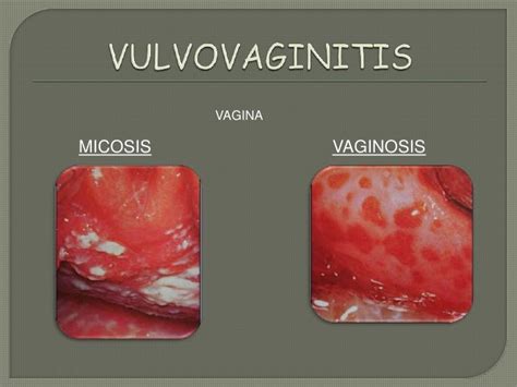 Vaginitis And Vulvovaginitis