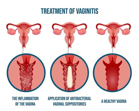 Vaginitis Causes Symptoms And Treatment
