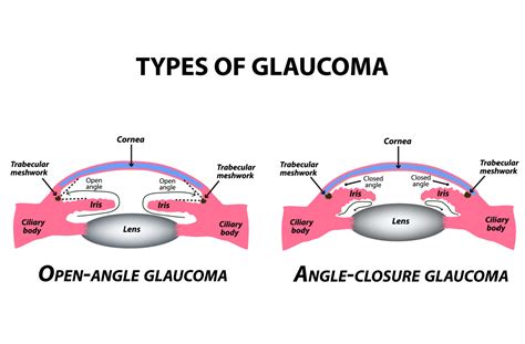 What Is Primary Open Angle Glaucoma Poag What Is Primary Open Angle Glaucoma Poag